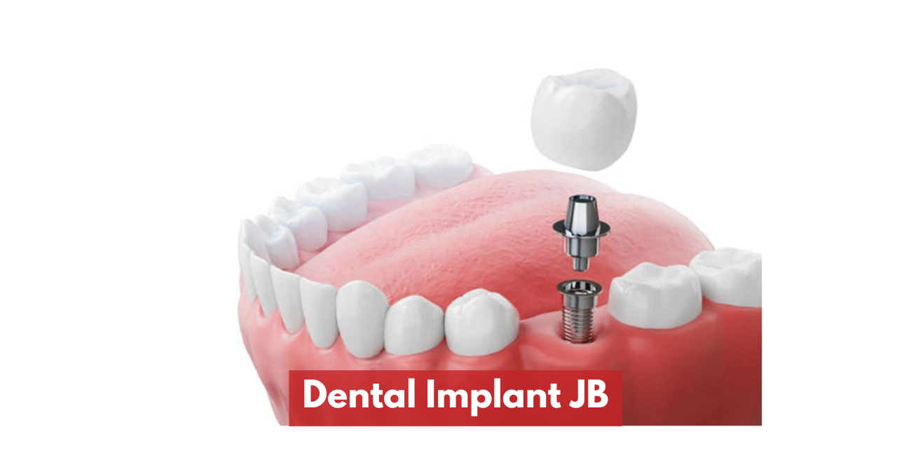 Dental Implant JB – Why More Patients Choose Johor Bahru for Implants